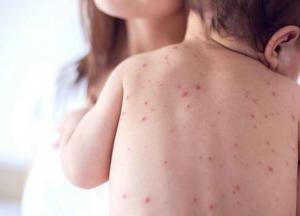 Может пострадать мозг: врач рассказал об ужасных последствий ветрянки