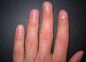 Медики рассказали, как по состоянию ногтей выявить меланому