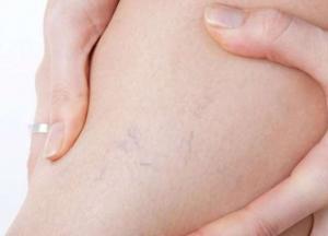 Названы пять признаков, свидетельствующих о наличии тромбов