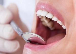 Ученые обнаружили связь между кариесом и инсультом