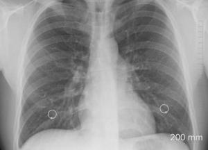 Медики перечислили пять симптомов рака легких