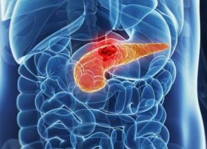 Медики назвали ранние симптомы рака поджелудочной железы