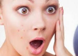 Эксперты назвали лучшие продукты для борьбы с прыщами на лице