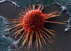 Названы пять симптомов рака, на которые нужно обратить внимание