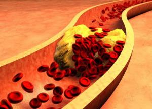 Медики рассказали, от каких лекарств повышается холестерин