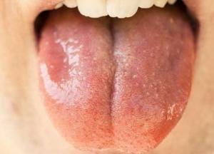 Онкологи назвали шесть признаков рака полости рта