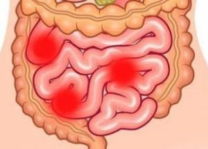 Названы продукты, которые могут вызвать непроходимость кишечника