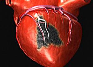 Названы симптомы надвигающегося инфаркта