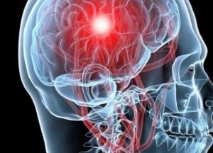 Названы самые эффективные способы предотвратить инсульт