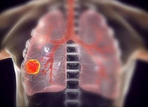 Онкологи указали на необычные признаки рака легких