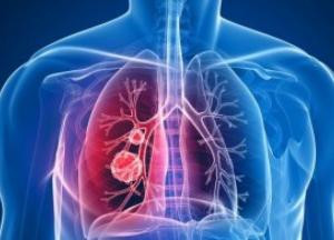 Медики рассказали, от какого вида рака умирает больше всего людей