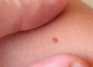 Онкологи рассказали, как распознать первые признаки рака кожи