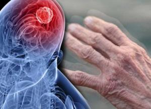 Назван ранний симптом болезни Паркинсона