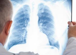 Медики назвали первые симптомы начинающейся пневмонии