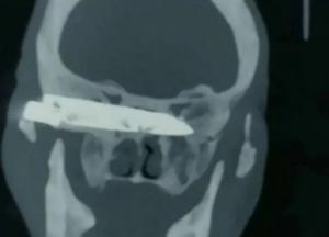 Мужчина 26 лет жил со ржавым ножом в голове прежде, чем его достали хирурги (фото)