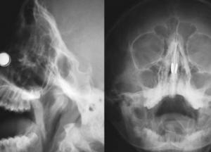 Австралийский ученый попал в больницу с магнитами в носу, пытаясь создать устройство от коронавируса