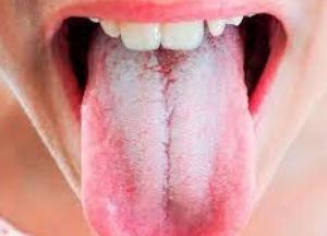 Врачи рассказали, о каких болезнях говорит налет на языке