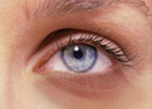 Как избавиться от синяков под глазами подручными способами