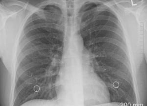 Медики назвали ранние симптомы рака легких