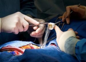 В Минздраве планируют включить "Черкасский кардиодиспансер" в пилотный проект по трансплантации