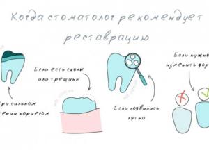 Что такое реставрация зуба, как проводят процедуру?