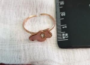 Во Львове годовалая девочка проглотила кольцо с острыми краями