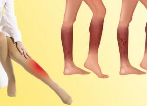 Эксперты назвали опасные симптомы тромбоза глубоких вен