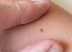 Врач рассказала, как выявить «раковые» родинки