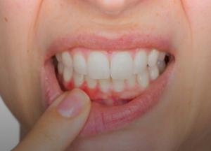 Врачи рассказали, о каких болезнях сигнализирует воспаление десен