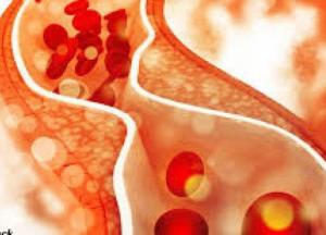 Врачи назвали простые способы снизить уровень холестерина