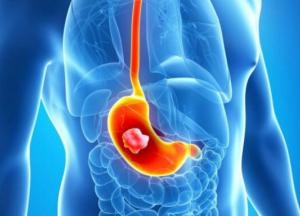 Ученые назвали самые распространенные симптомы рака желудка
