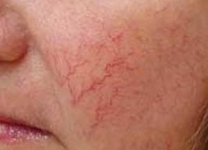 Медики рассказали, о каких болезнях предупреждают лопнувшие капилляры