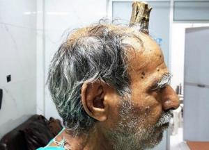 Диагноз "Рог дьявола": в Индии мужчине в ходе операции удалили 10-сантиметровый рог (фото)