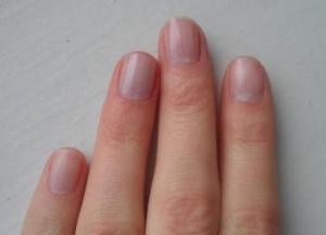 Синие ногти могут быть признаком опасной болезни