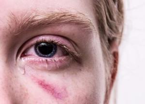 Медики рассказали, при появлении каких синяков нужно срочно обращаться к врачу