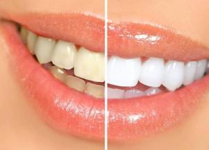 Стоматологи подсказали, как отбелить зубы в домашних условиях