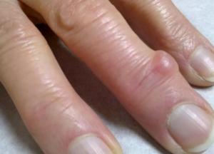 Назван малоизвестный симптом возможного сердечного приступа