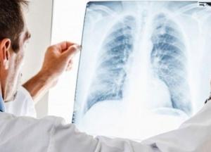 В Украине обновили стандарты медпомощи больным туберкулезом