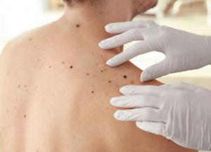 Врачи назвали опасные родинки на теле человека