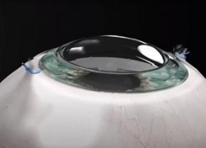 Ученые смогли за сутки восстановить зрение у слепого пациента