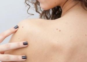 Медики назвали пять признаков опасной родинки