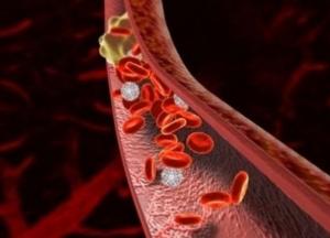Врачи назвали первые признаки тромбоза