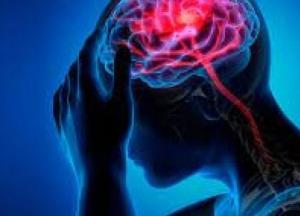 Медики назвали три главных признака инсульта