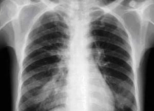 Медики назвали ранние признаки рака легких