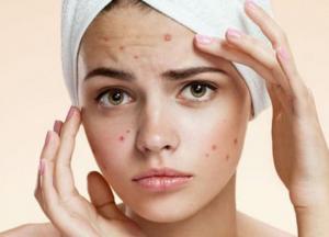 О каких проблемах со здоровьем говорят прыщи на разных частях лица 