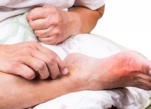 Врачи установили связь между свининой в рационе и подагрой