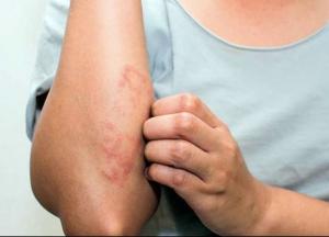 Виды и особенности применения дерматологических препаратов