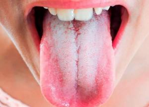 Медики предупредили о новом странном симптоме коронавируса