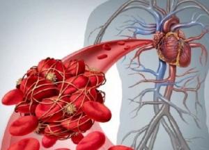 Медики рассказали, что вызывает тромбоз