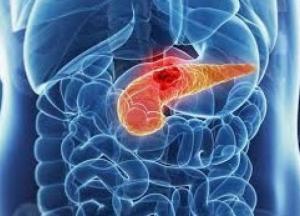 Онкологи рассказали, как выявить рак поджелудочной железы на ранней стадии
